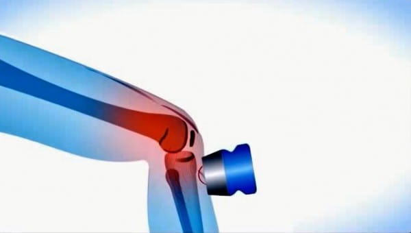 Ultraschallanwendung Kniegelenk