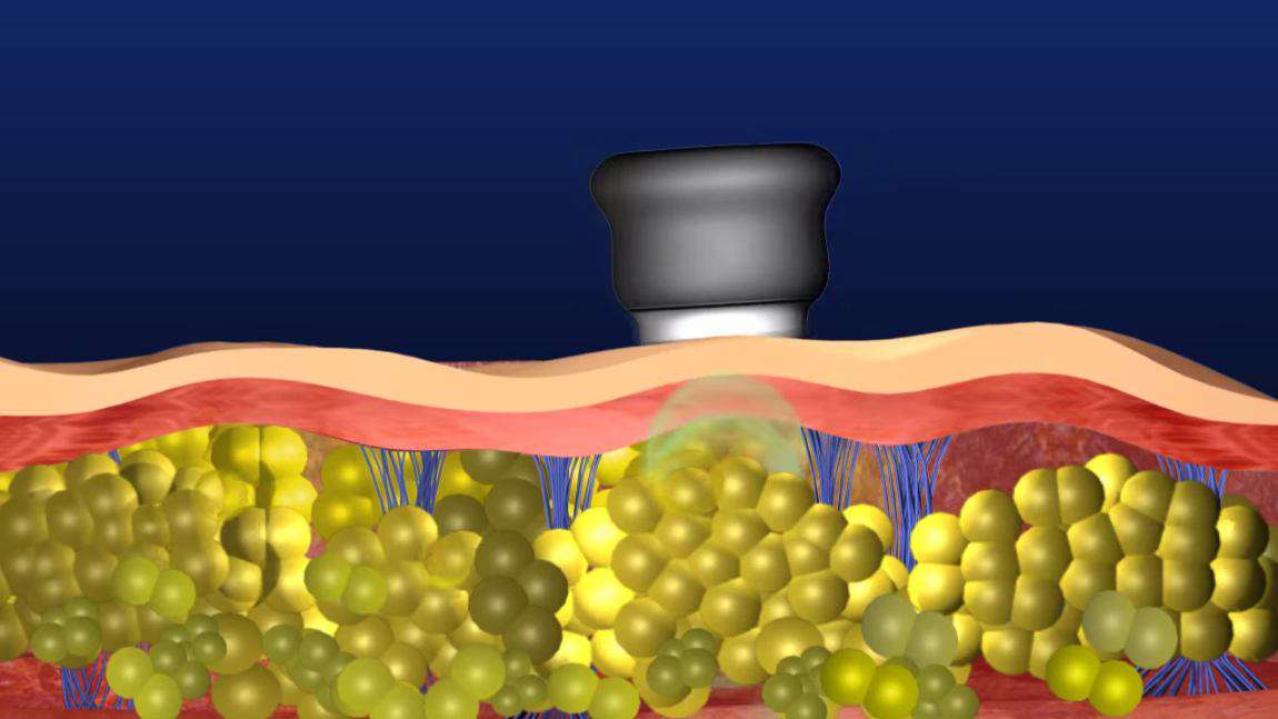 Ultraschall Kavitationsgerät für zu Hause Lipozero G39